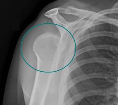 Shoulder Dislocation X-ray